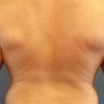 Male Liposuction Before & After Patient #7731