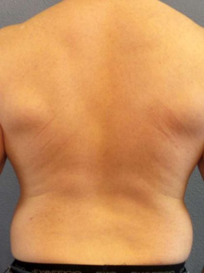 Male Liposuction Before & After Patient #7731