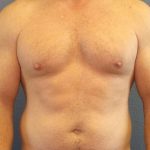 Male Liposuction Before & After Patient #7731