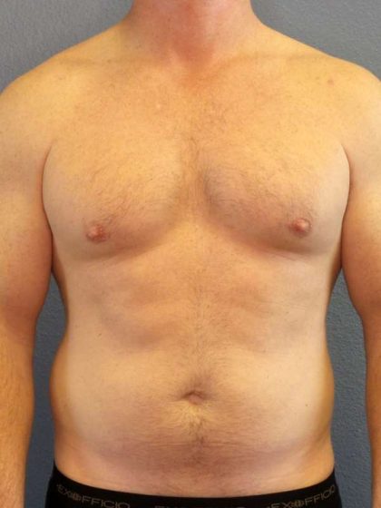Male Liposuction Before & After Patient #7731