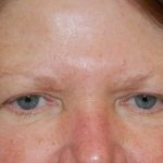 Periorbital Before & After Patient #8530