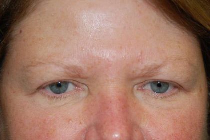 Periorbital Before & After Patient #8530