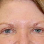 Periorbital Before & After Patient #8530