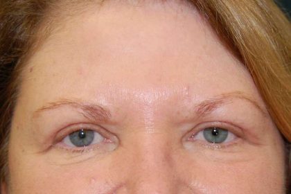 Periorbital Before & After Patient #8530