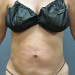 Liposuction Female Before & After Patient #7984