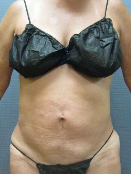 Liposuction Female Before & After Patient #7984