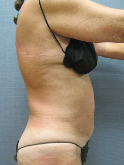 Liposuction Female Before & After Patient #7984