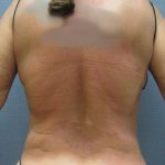 Liposuction Female Before & After Patient #7984