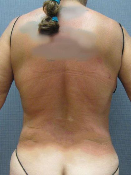 Liposuction Female Before & After Patient #7984