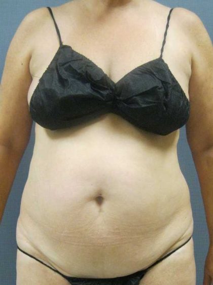 Liposuction Female Before & After Patient #7984