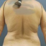 Liposuction Female Before & After Patient #7984