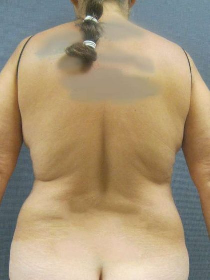 Liposuction Female Before & After Patient #7984