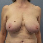 Breast Lift with Implant (Augmentation Mastopexy) Before & After Patient #4001