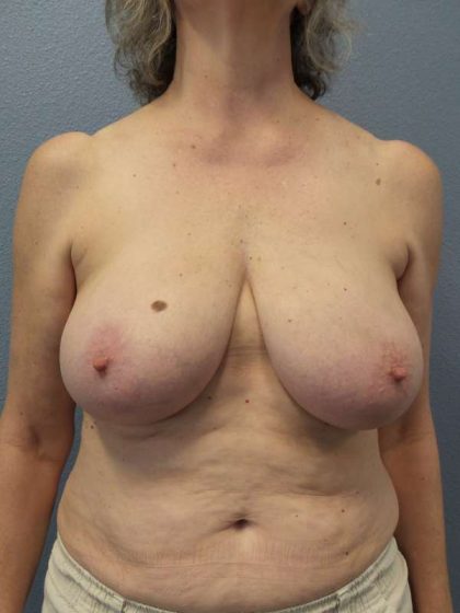 Breast Lift with Implant (Augmentation Mastopexy) Before & After Patient #4001