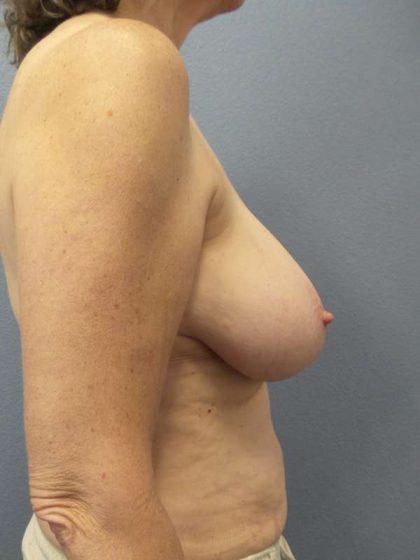 Breast Lift with Implant (Augmentation Mastopexy) Before & After Patient #4001