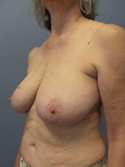 Breast Lift with Implant (Augmentation Mastopexy) Before & After Patient #4001