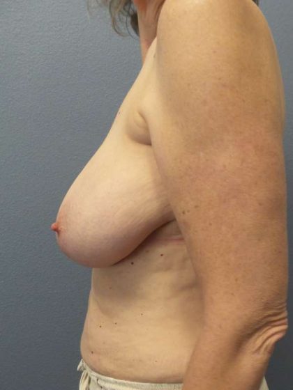Breast Lift with Implant (Augmentation Mastopexy) Before & After Patient #4001