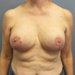 Breast Lift with Implant (Augmentation Mastopexy) Before & After Patient #4001