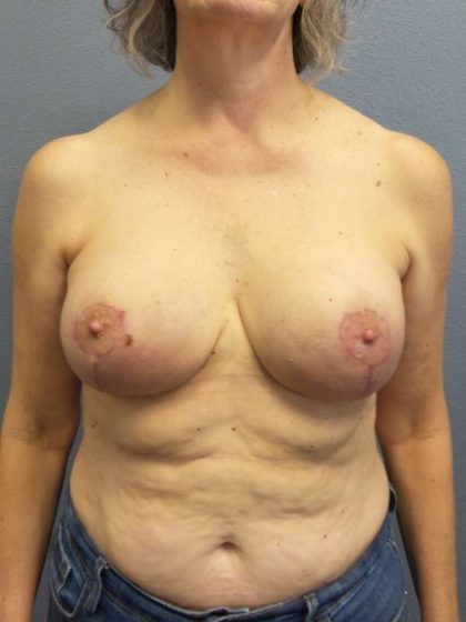 Breast Lift with Implant (Augmentation Mastopexy) Before & After Patient #4001