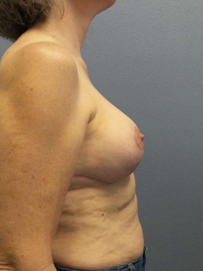 Breast Lift with Implant (Augmentation Mastopexy) Before & After Patient #4001