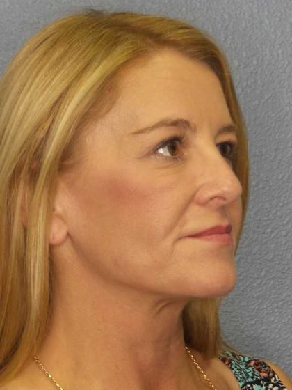 Resurfacing Before & After Patient #8816