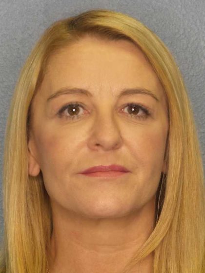 Resurfacing Before & After Patient #8816