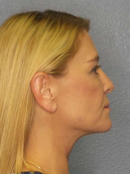 Resurfacing Before & After Patient #8816