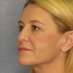 Resurfacing Before & After Patient #8816