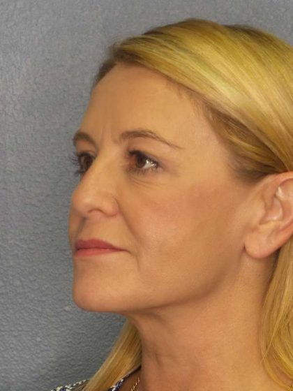 Resurfacing Before & After Patient #8816