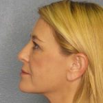 Resurfacing Before & After Patient #8816