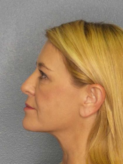 Resurfacing Before & After Patient #8816