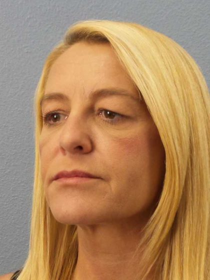 Resurfacing Before & After Patient #8816