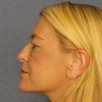 Resurfacing Before & After Patient #8816