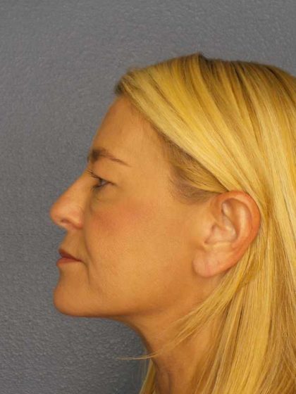 Resurfacing Before & After Patient #8816