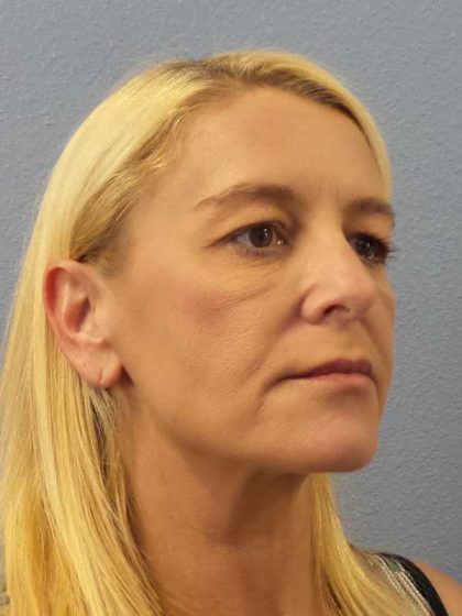 Resurfacing Before & After Patient #8816