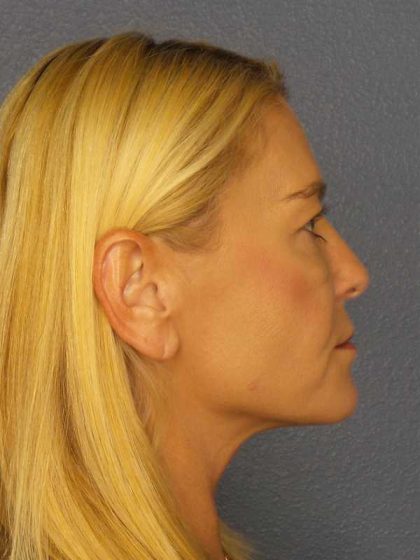 Resurfacing Before & After Patient #8816