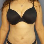 Liposuction Female Before & After Patient #8001