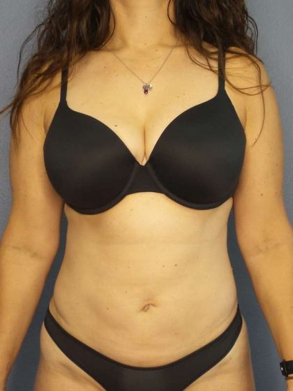 Liposuction Female Before & After Patient #8001