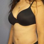 Liposuction Female Before & After Patient #8001