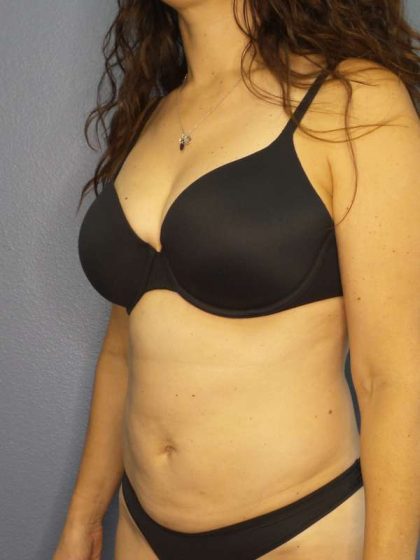Liposuction Female Before & After Patient #8001