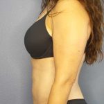 Liposuction Female Before & After Patient #8001