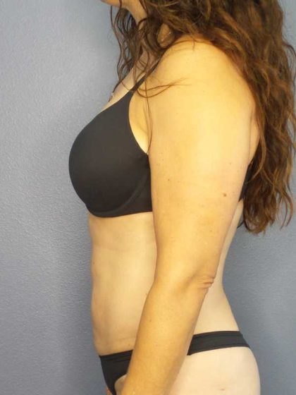 Liposuction Female Before & After Patient #8001