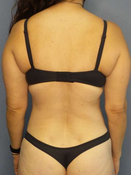 Liposuction Female Before & After Patient #8001
