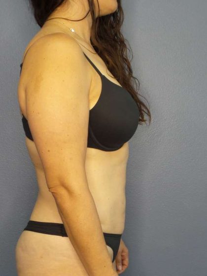 Liposuction Female Before & After Patient #8001