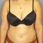 Liposuction Female Before & After Patient #8001