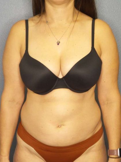 Liposuction Female Before & After Patient #8001