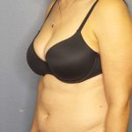 Liposuction Female Before & After Patient #8001