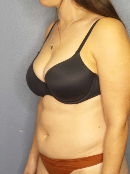 Liposuction Female Before & After Patient #8001