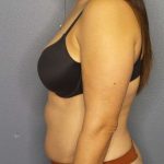 Liposuction Female Before & After Patient #8001