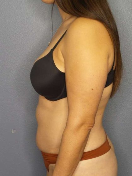Liposuction Female Before & After Patient #8001